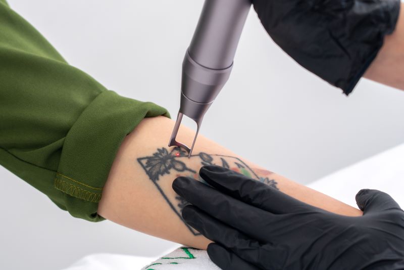 TATOO REMOVAL