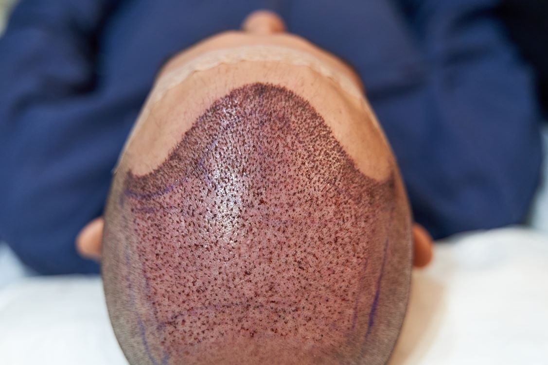 Robotic hair transplant
